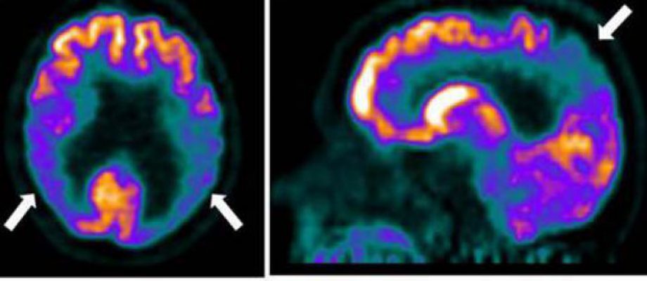 Collaboration aimed at long-term Alzheimer’s genetics, biomarkers study